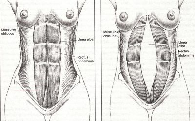 Diastasis abdominal embarazo que hacer